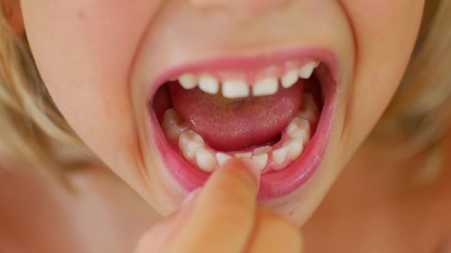 The child shows his first staggering tooth. Finger loosens baby's tooth.