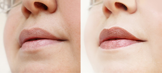 lips and lower face of a middle-aged woman in two versions, fine wrinkles on the face, spots, the...