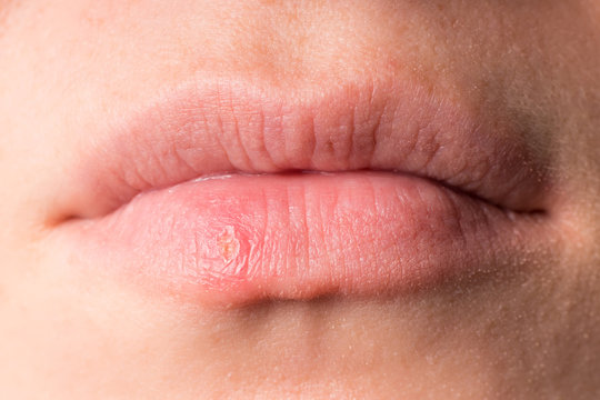 Skin disease on the lips. Herpes virus infection.