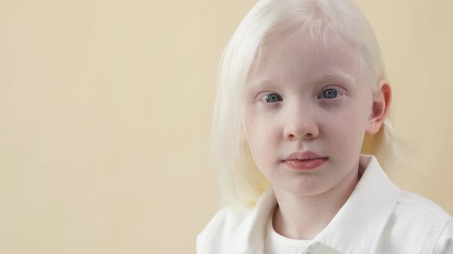 Close-up portrait of little caucasian girl with albinism syndrome. Child look at camera. Abnormal deviations. unusual appearance.