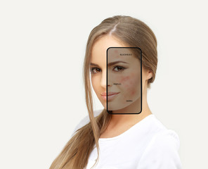 Post-Acne Marks /Treating Acne Scars.Acne Scar Removal	
