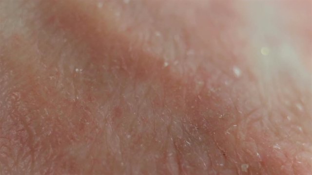 Atopic dermatitis from stress, allergies, fungal or bacterial infection, systemic lupus erythematosus, autoimmune processes. Red spots of the affected epithelium, severe itching, scabies. The affected