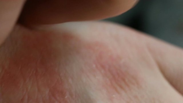 Severe itching, allergic reaction, fungal infection, scabies. The affected skin has red spots, irritation, papules, peeling, eczema. Extreme close-up, real time, contains people.