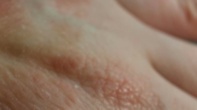 Atopic dermatitis caused by stress, allergies, fungal or bacterial infection. Red spots of the affected epithelium, severe itching, scabies. Comb your skin with your nails. Extreme close-up, real time