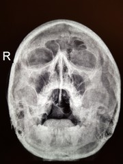 X-ray of a human head