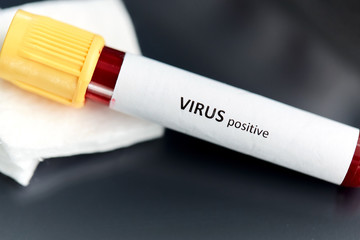 medicine, healthcare and pandemic concept - close up of beaker with positive virus blood test on table at laboratory
