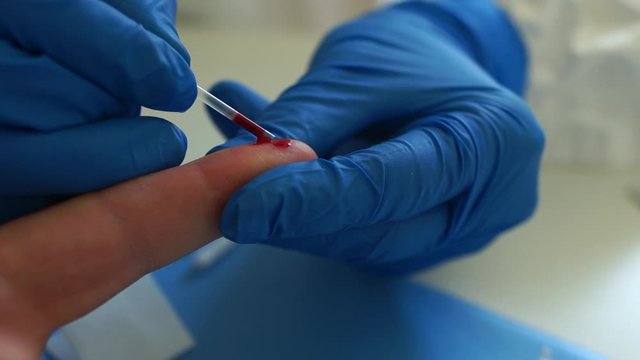 Close-up blood sampling for analysis on coronovirus covid-19. Test cassette for determination of the virus SARS-CoV-2. Rapid test covid 19. Serological blood test