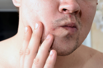 Obraz premium dermatological problems with skin on the face of a man.