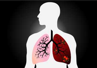 Comparison between healthy lung and cancer lung isolated on white background. Healthy lung and 
Pneumonia. Lung was infected by pathogen 