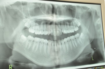歯科レントゲン