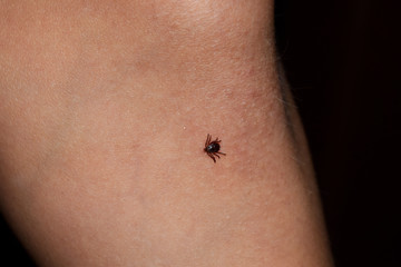 A small tick on a child’s leg. Dangerous insect, the carrier of many diseases.