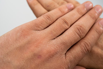 Close-up of the hands of a man with dry, severely dehydrated skin with fragments of epidermis that exfoliate due to excessive use of alcohol-based disinfectants during coronavirus (Covid-19) pandemic.