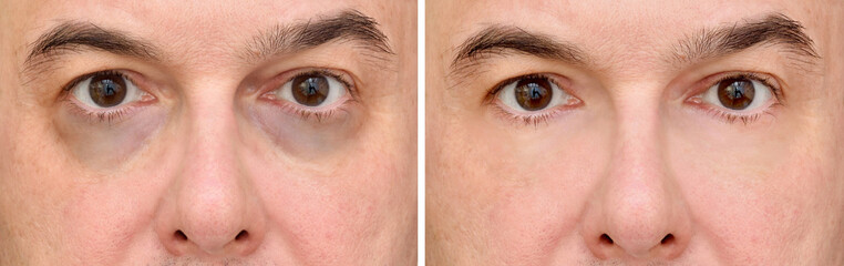 Male eye bags before and after cosmetic treatment or plastic procedure, blepharoplasty. Close-up.