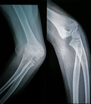 Close-up Of X-ray