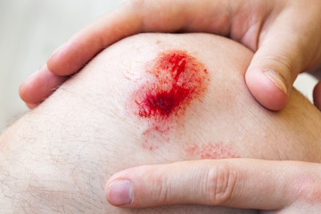 Deep scratches on the skin with bruises and wet tracks