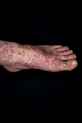 Obraz na płótnie Canvas Psoriasis (eczema) on foot isolated on black background