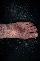 Obraz na płótnie Canvas Psoriasis (eczema) on the foot Man itching skin Psoriasis scales are scattered on black background