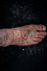 Fototapeta na wymiar Psoriasis (eczema) on the foot Man itching skin Psoriasis scales are scattered on black background