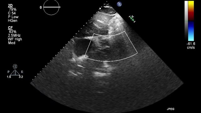 Ultrasound transesophageal examination of the heart.