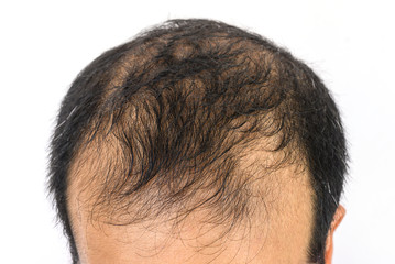 Close up of Male-pattern baldness typically appears first at the hairline or top of the head. It...