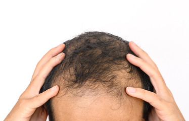 Fototapeta premium Close up of Male-pattern baldness with white copy-space, typically appears first at the hairline or top of the head. It can progress to partial or complete baldness.