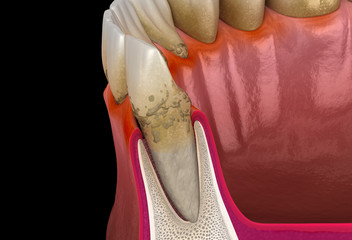 Periodontitis stage 2, gum recession, tartar. Medically accurate 3D illustration