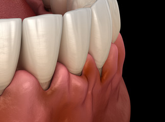 Gingivitis inflammation of the gums. Medically accurate 3D illustration