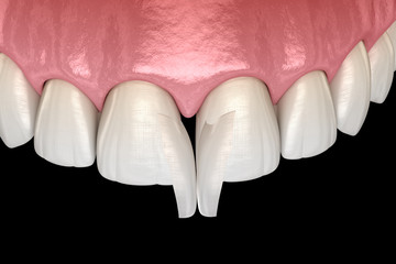Diastema treatment: Micro veneer installation procedure over central incisor. Medically accurate tooth 3D illustration