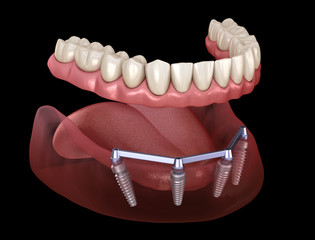 Removable Mandibular prosthesis with gum All on 4 system supported by implants. Medically accurate 3D illustration of human teeth and dentures - obrazy, fototapety, plakaty