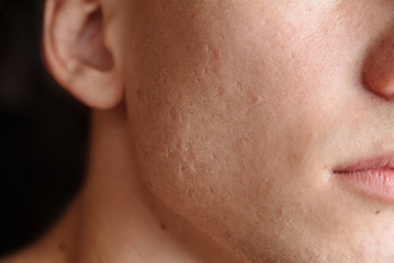 Acne scars on the face