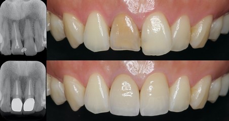 前歯　審美歯科　セラミック治療