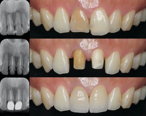 前歯　審美歯科治療