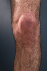 Naklejka premium The hairy knee on a dark background. Medical concept.