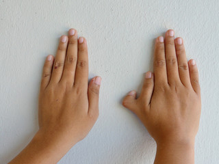 Polydactyly on human; rare abnormal characteristic causes by chromosome.