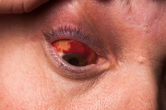 Frau mit Bindehautentz&uuml;ndung im Auge