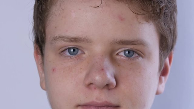 A cute teen boy with blond hair and blue eyes with problem skin and teenage acne is looking at the camera on a white background. Dermatological problems in a teenager. Young guy in a transitional age.