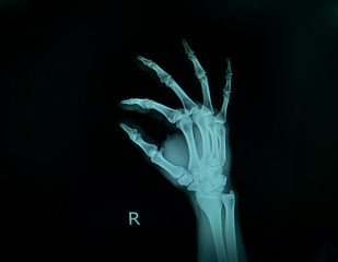 x-ray image show right hand.