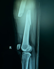 film x-ray of fracture right thigh.