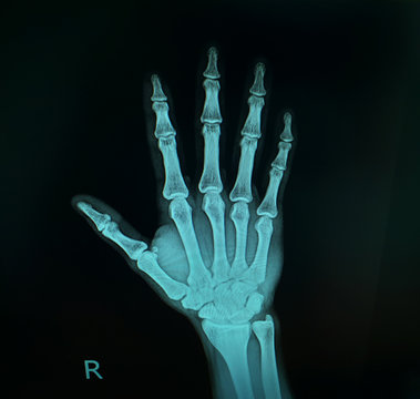 x-ray image show right hand.