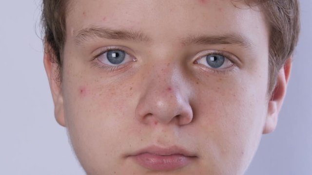 A cute teen boy with blond hair and blue eyes with problem skin and teenage acne is looking at the camera on a white background. Dermatological problems in a teenager. Young guy in a transitional age.