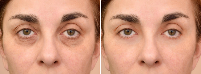 Female eye bags before and after cosmetic treatment or plastic procedure, blepharoplasty. Close-up.