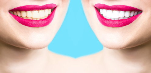 Teeth whitening concept. Smiling woman with healthy white and yellowed teeth. Dentistry