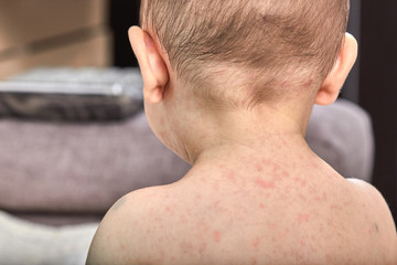 roseola rash a viral rash on the skin of a child