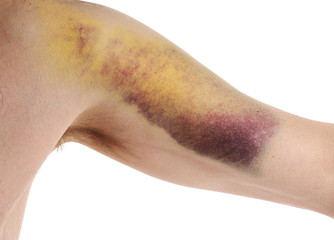 Hematoma, bruise caused by injection on arm isolated on white background