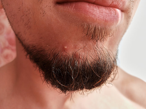 a young man with a pimple in his beard