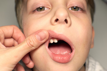 Kid showing missing teeth, he has lost two calfs teeth. Close up portrait of blonde caucasian boy...
