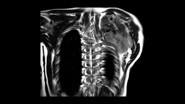 Magnetic resonance (MRI) of Shoulder Joint History:Case Lt. shoulder mass.