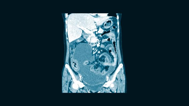 CT Scan Whole abdomen  finding fatty mass with calcification at Rt adnexa, representing dermoid cyst.