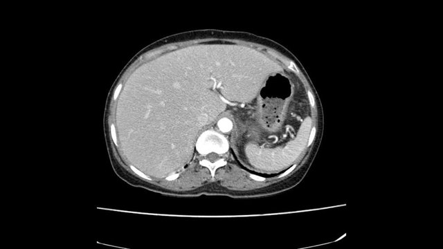 CT Whole abdomen  finding fatty mass with calcification at Rt adnexa, representing dermoid cyst.