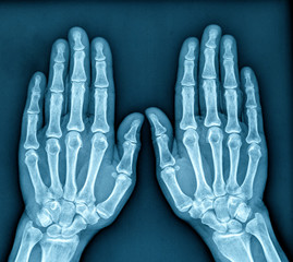 X ray Image of both human hands